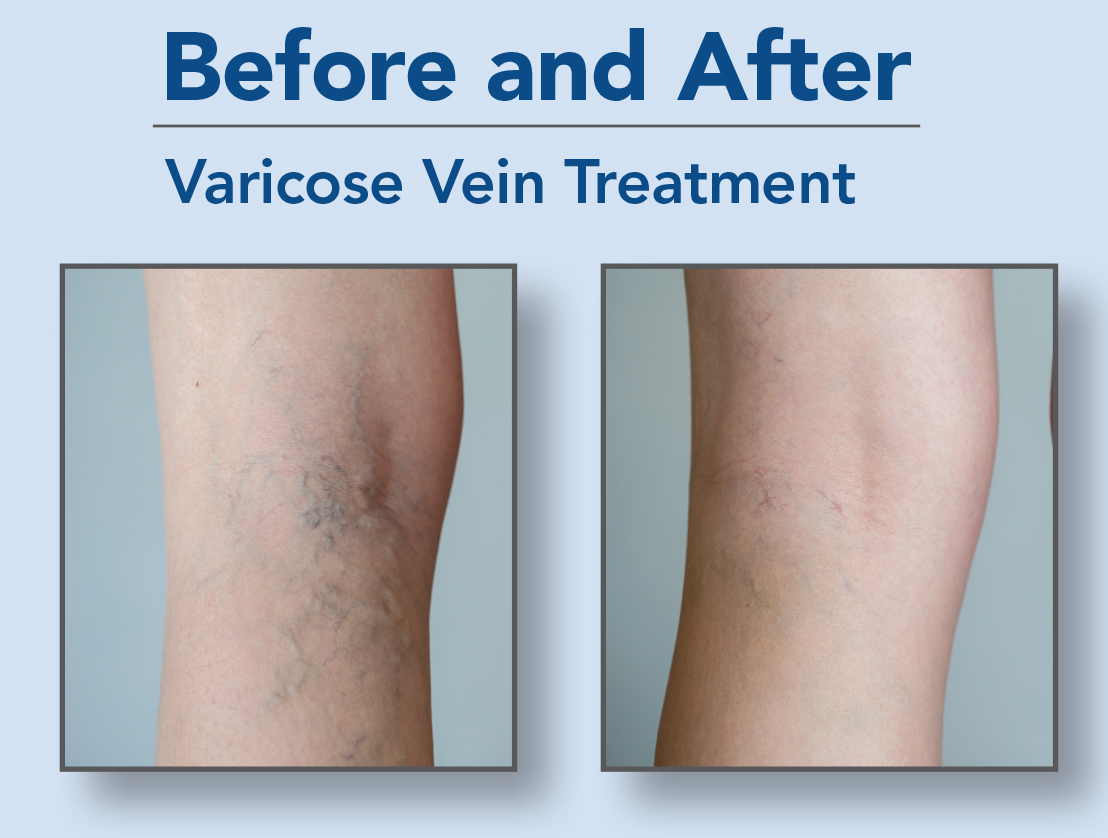 Before and After Varicose Vein Treatment Before and After Varicose Vein Treatment