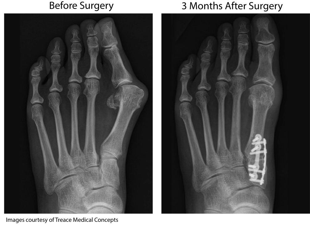 Bunion before Lapiplasty vs 3 months after surgery