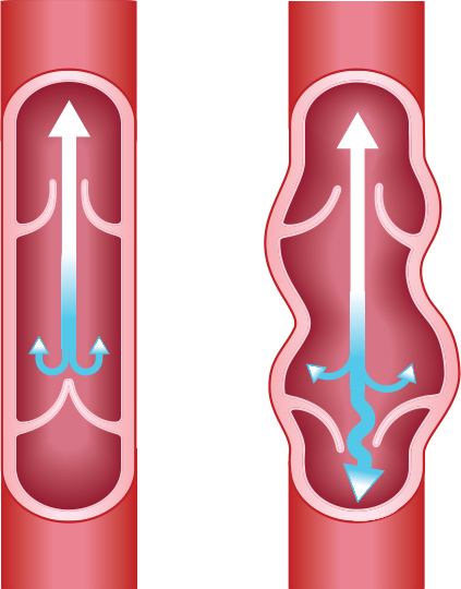 venous insufficiency venous insufficiency