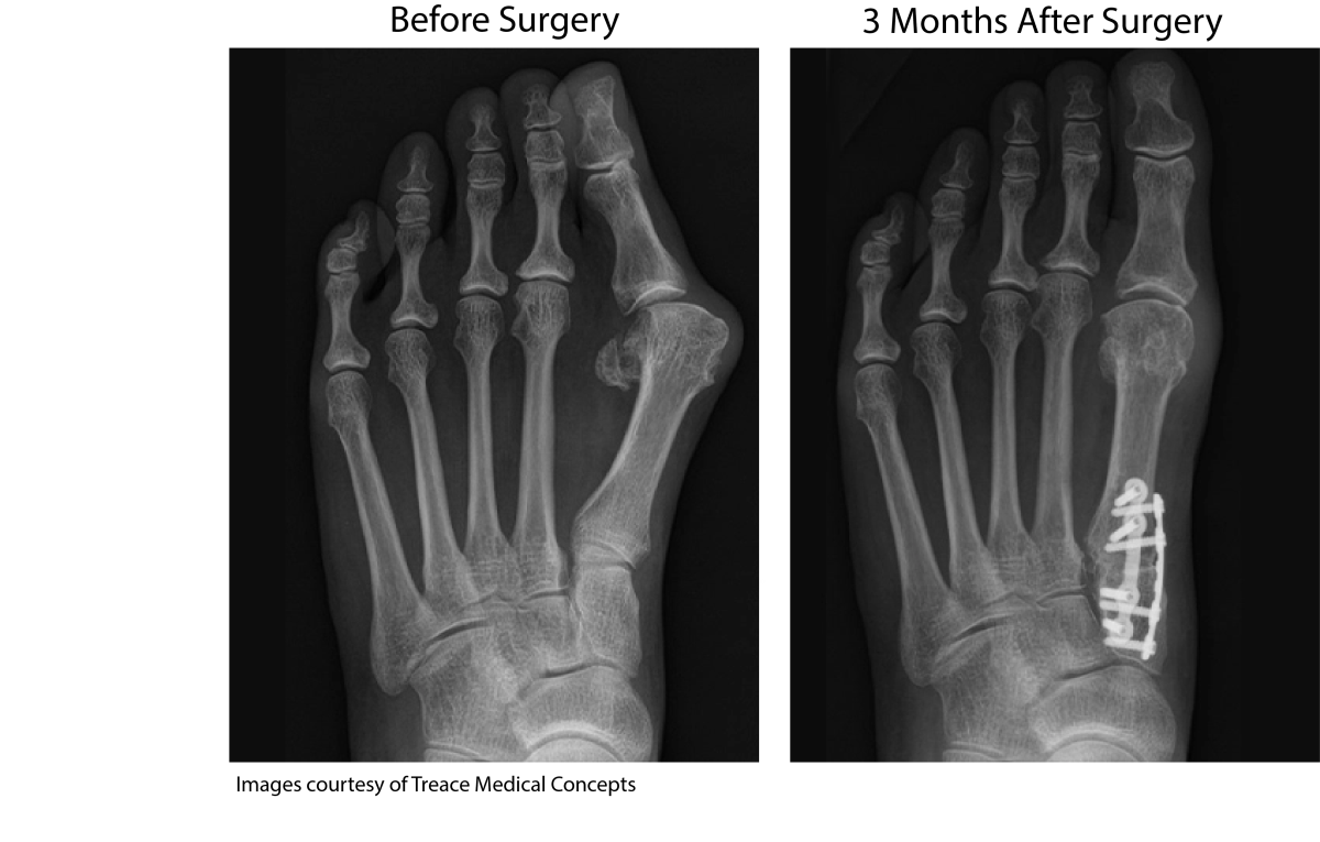 Bunion before surgery versus three months after Lapiplasty surgery